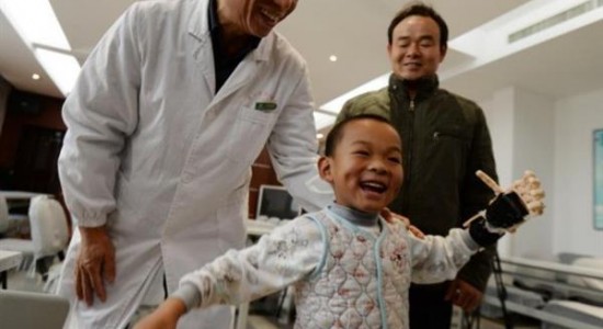 first-burn-victim-3d-prosthetic-china-five-year-old-boy