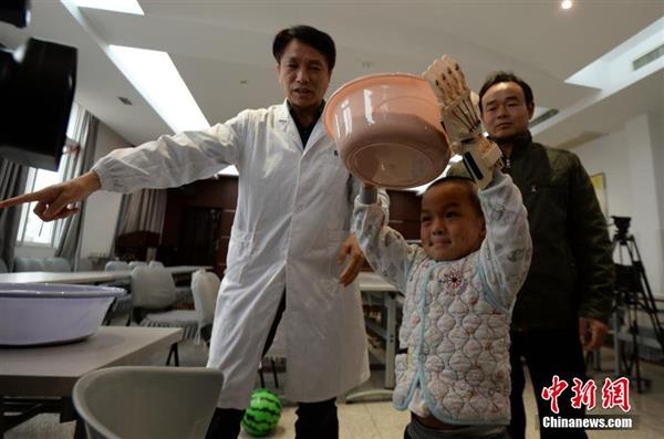 first-burn-victim-3d-prosthetic-china-five-year-old-boy4
