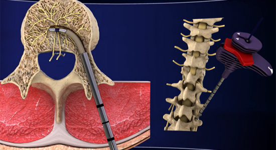 سامانه قطع عصب داخل مهره Intracept