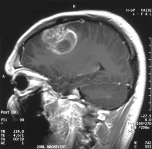 بیماران مبتلا به تومور مغزی به کمک میدان‌های الکتریکی عمر طولانی‌تری خواهند داشت