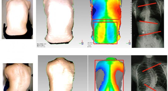 تشخیص اسکولیوز بد شکلی ستون فقرات در مراحل ابتدایی