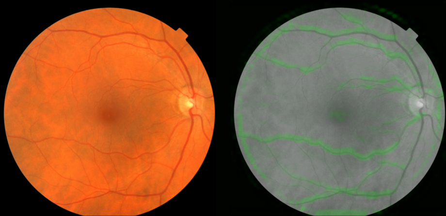 نحوه تشخیص رگ های خونی با الگوریتم گوگل برای سنجش فشار خون، در تصویر Fundus یا سطح داخلی چشم مقابل عدسی نمایش داده شده است.