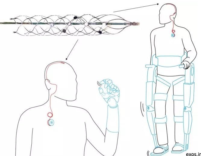 درمان آسیب نخاعی