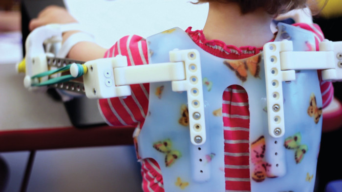 کودکی که به کمک اسکلت بیرونی چاپ سه بعدی توانست دستهایش را حرکت داده و بازی کند