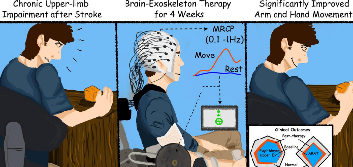 بهبود توانبخشی سکته مغزی با تلنگری به مغز