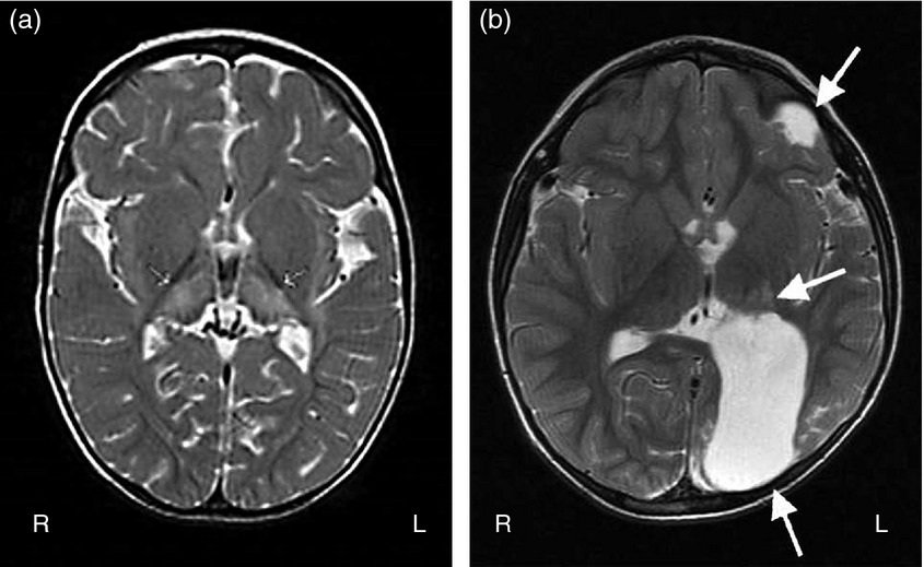 اسیب ماده خاکستری مغز که منجر به فلج مغزی است.  ماده خاکستری از جسم نورونها، Neuropil، آکسونهای غیر میلینه، سلولهای گلیال و مویرگها تشکیل شده است. 