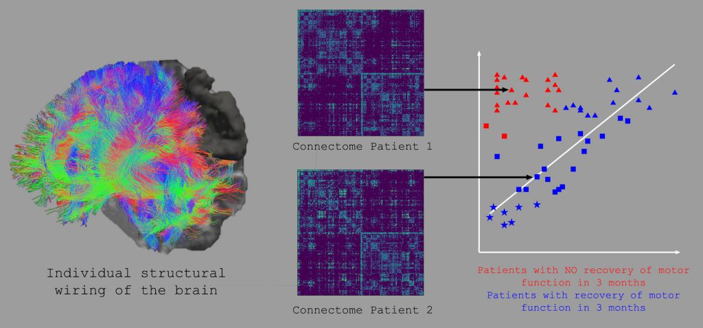 پیش بینی میزان بهبودی پس از سکته مغزی با یادگیری ماشین