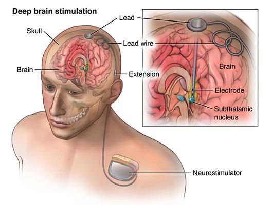 Sapiens Neuro: توسعه دهنده دستگاه تحریک مغز برای درمان اختلالات عصبی