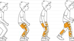 اسکلت بیرونی پایین تنه برای کمک به راه رفتن خمیده در کودکان مبتلا به فلج مغزی