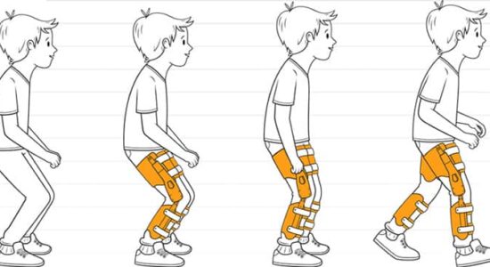 اسکلت بیرونی پایین تنه برای کمک به راه رفتن خمیده در کودکان مبتلا به فلج مغزی