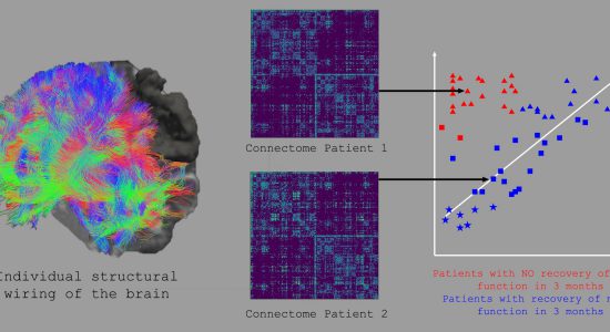 پیش بینی میزان بهبودی پس از سکته مغزی با یادگیری ماشین