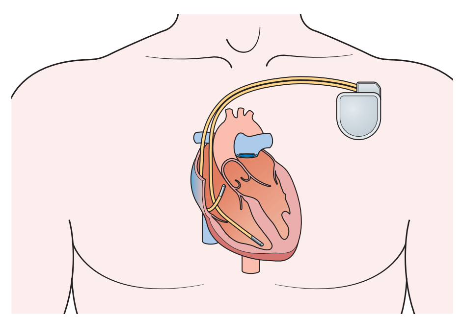 پزشکی محاسباتی و شبیه سازی قلب برای درمان آریتمی قلب در دانشگاه John Hopkins