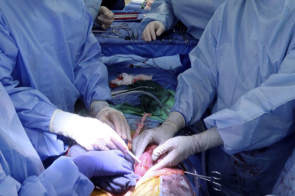  جراحان آمریکایی کلیه‌های خوک را به یک بیمار مرگ مغزی پیوند زدند 