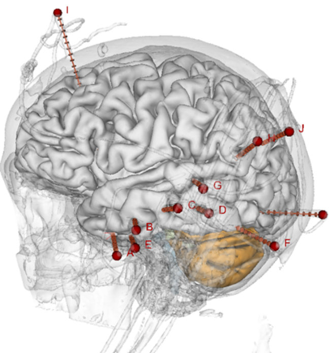 stereo electro encephalography یا SEEG 